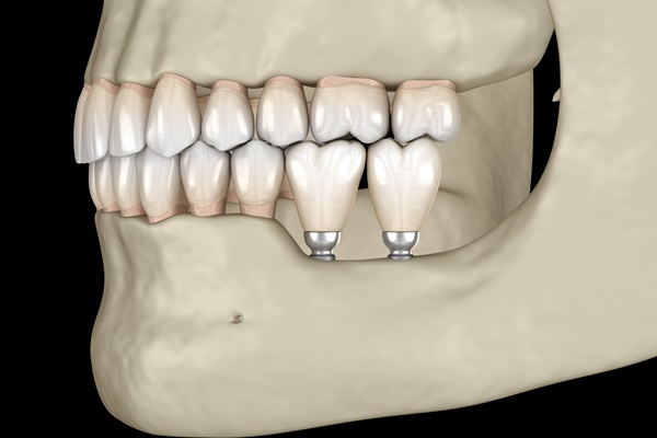 How Are Mini Dental Implants Placed?