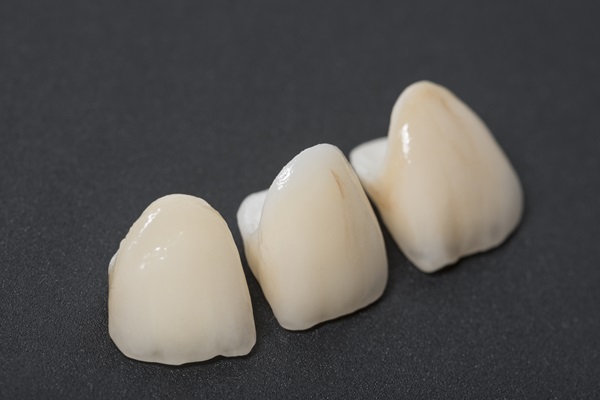 Same Day Crowns Vs  Traditional Crowns: Which Is Right For You?